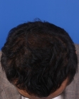 After Hair Transplant&nbsp;2 Sessions (Areas)